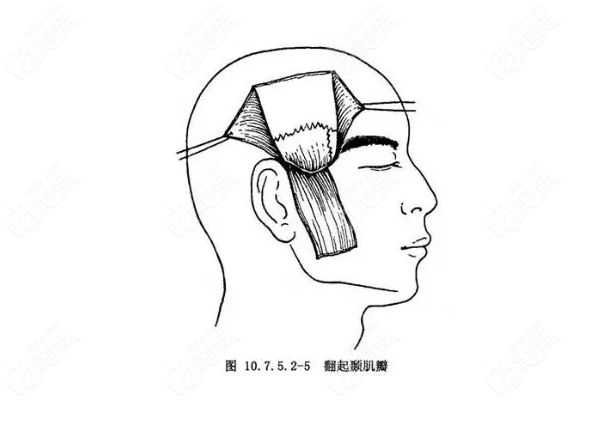 颞筋膜瓣位置图解