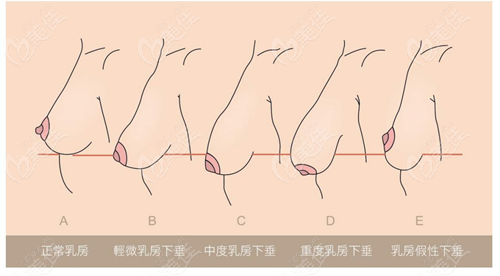 乳房下垂分度图片
