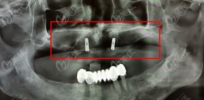 上半口半固定种植牙做好后拍的CT照