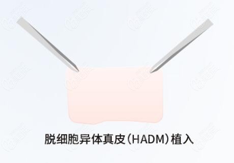 男性生物补片手术好吗