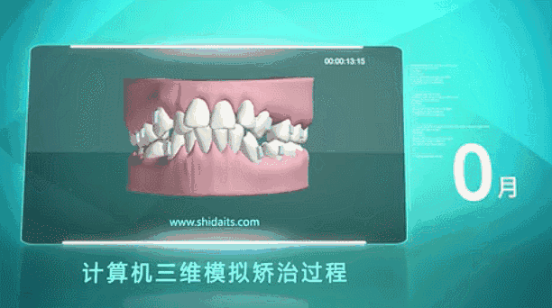 3D动画模拟牙齿矫正过程
