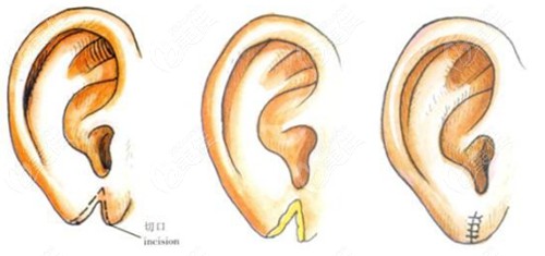 耳垂裂缝合修复术过程