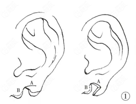 耳垂裂“Z”成形术方法