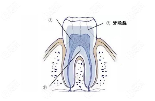 牙隐裂的症状表现