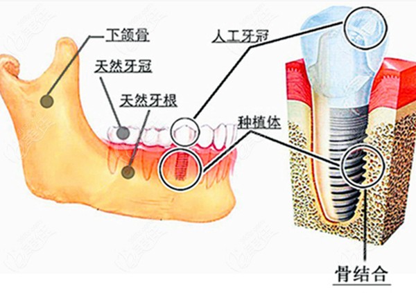 听说昆明网上预约种牙三千多元,那做全口树脂牙一般需要多少钱?