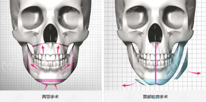面部骨头不对称怎么办？推荐做下颌角/正颌/下巴截骨手术矫正