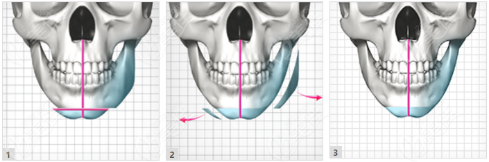 牙齿正常咬合，下巴大小不对称的面部骨骼不对称推荐做下颌角手术