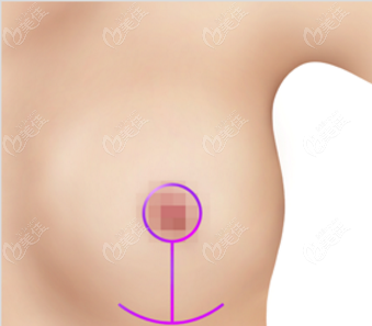 乳房下垂提升手术操作步骤