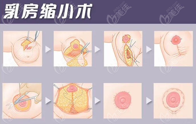 乳房缩小手术图示