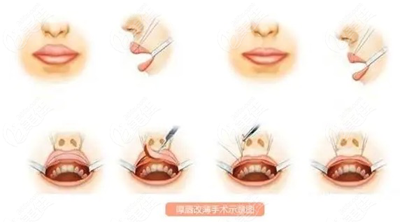 厚唇改薄手术过程展示图