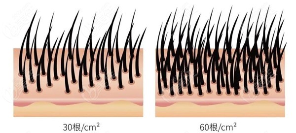 植发密度的对比