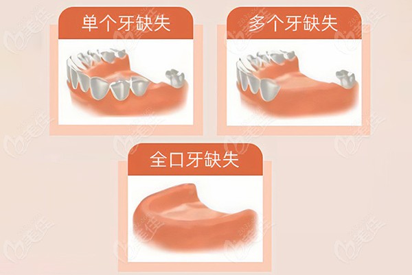 悦牙口腔种植修复