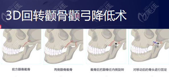 南京友谊的3D回转颧骨颧弓降低术