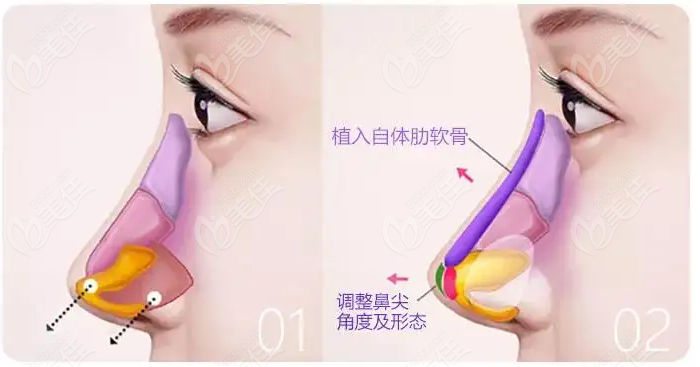 鼻头挛缩怎么修复？分享鼻子挛缩的修复方法