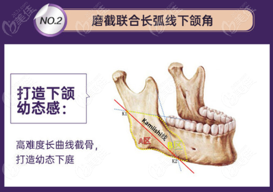 景氏风格磨截长弧线下颌角术