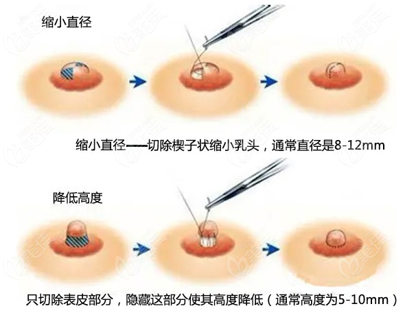 棒棒糖缩胸手术图片