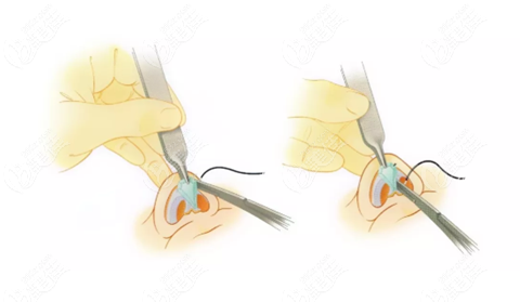 王丹丹鼻修復(fù)技術(shù)原理 王丹丹鼻修復(fù)技術(shù)原理