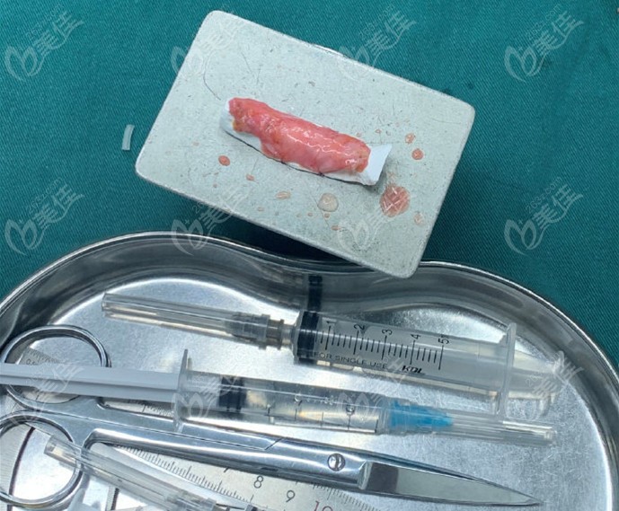 筋膜包裹假體圖 筋膜包裹假體圖