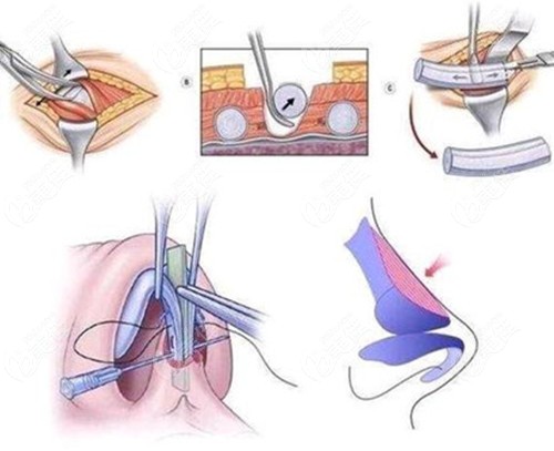 肋骨鼻修復(fù)過程圖 肋骨鼻修復(fù)過程圖