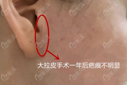 大拉皮手术一年后疤痕不明显