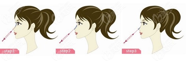 <!--<i data=20240703-sp></i>-->爱贝芙注射隆鼻