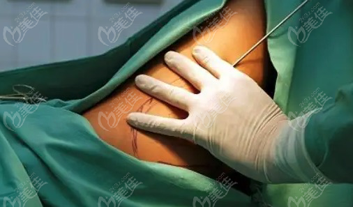 小肚子可以做吸脂手术吗如果在小肚子抽脂大概要多少钱呀