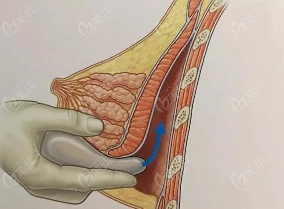 乳房下皱襞切口位置及放置假体过程图解