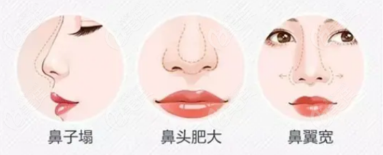 鼻整形可以只做鼻头吗