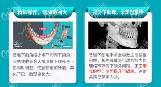 广州下颌角手术有名医生