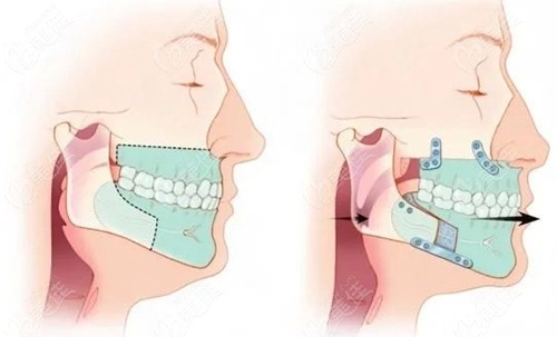 正颌手术方法以及固定