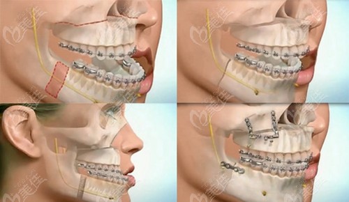 反颌矫正之后及时做牙齿矫正