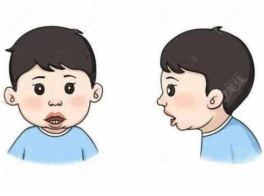 儿童在替牙期矫正可以避免上颌前突