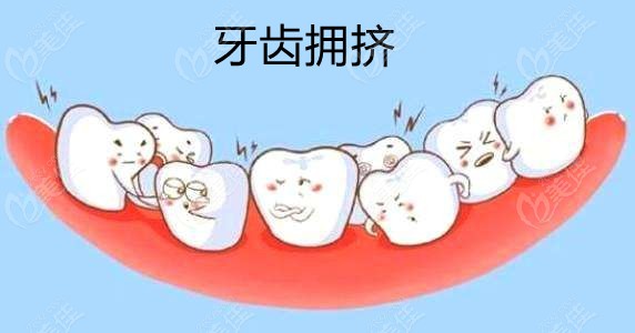换牙期进行早期干预矫正可解决牙齿拥挤
