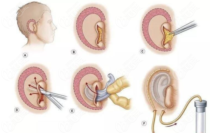成都耳再造医生排名:/康春雨/做耳畸形矫正都挺好