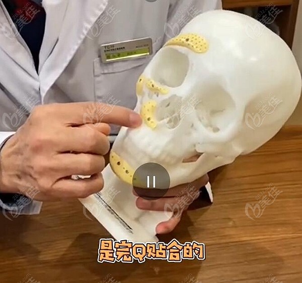 3D打印人工骨填充鼻基底不会移位