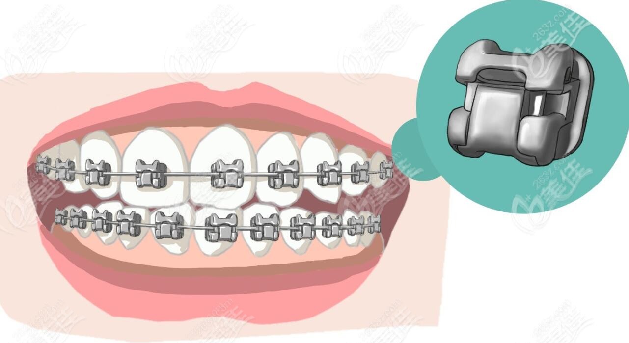 金属牙齿矫正收费不贵