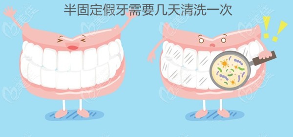 半固定假牙需要几天洗一次呢？