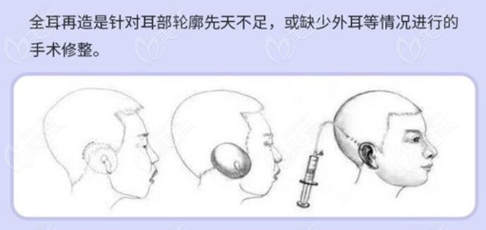 全扩张皮肤法耳再造手术过程
