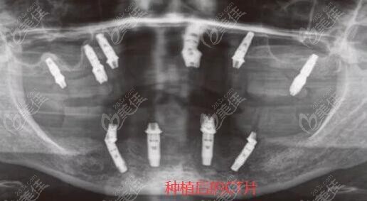 活動假牙換做種植牙修復(fù)