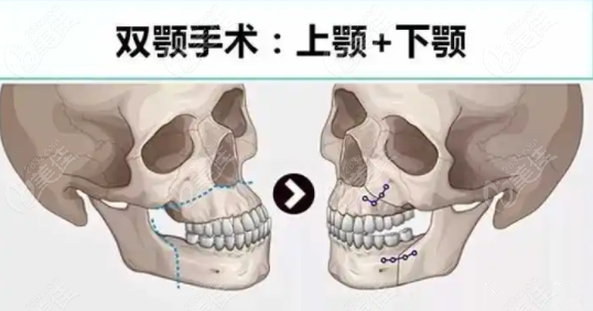偏颌可通过双颚手术来改善