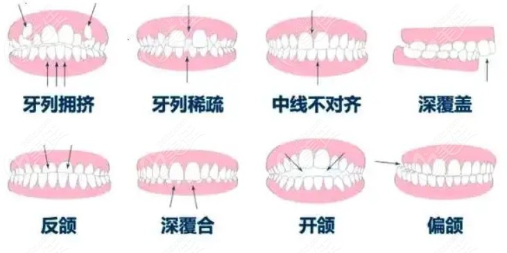 牙齿不齐的类型