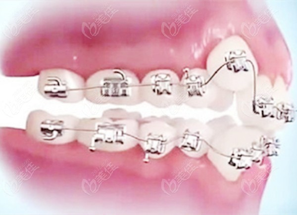 牙齿矫正金属托槽的图片