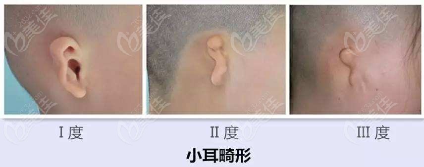 小耳畸形的三种程度