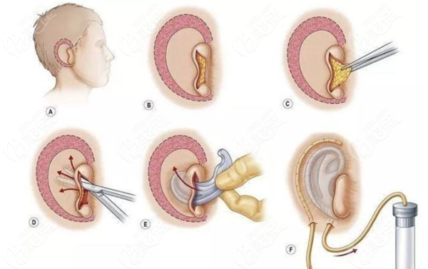 小耳畸形再造手术过程