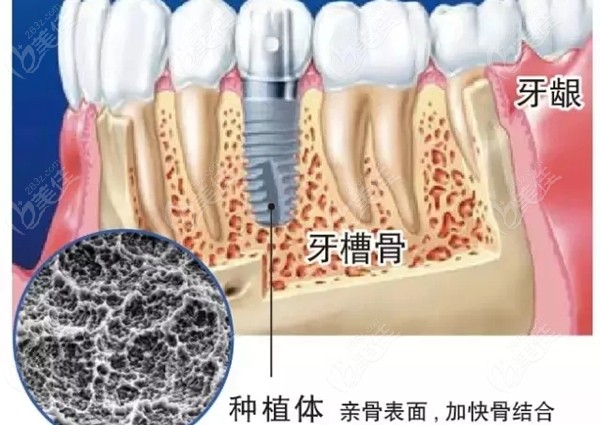 种植牙相关的牙槽骨的图