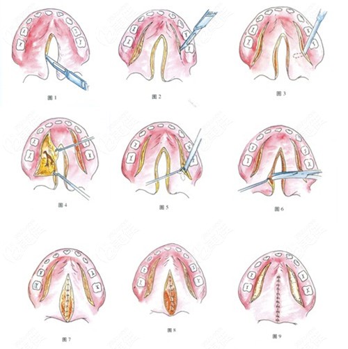 腭裂修复术术示意图图片