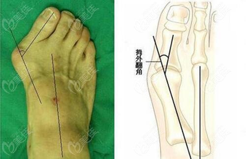 瀋陽哪家醫院做微創治療大腳骨手術好拇外翻矯正選這兩家醫院很靠譜