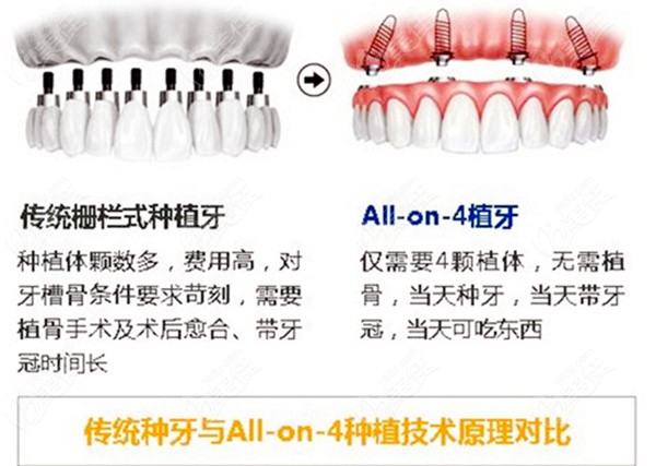 传统种牙与all on 4种牙原理对比