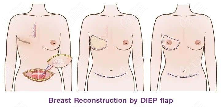 皮瓣乳房再造手术过程