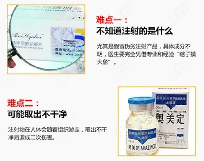 国内奥美定取出难度大